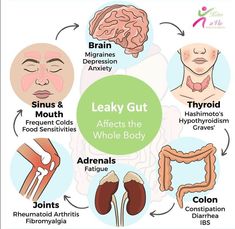 Keto A Vie on Instagram: "9 Leaky Gut Symptoms Problems in our gastrointestinal (GI) tract can cause more than just stomach pain 😥, gas 🤢, bloating, or diarrhea; they can be the root cause of many chronic health problems. If your intestinal wall has been compromised, and you have leaky gut, you’ll likely experience these symptoms and signs: 1. Digestive issues such as gas, bloating, diarrhea, or irritable bowel syndrome (IBS) 2. Food allergies 🤧 or food intolerances. 3. Brain fog 🧠 difficult Herbalife Aloe, Leaky Gut Symptoms, Gut Problems, Gut Brain, Digestive Issues, Gi Tract, Irritable Bowel, Seasonal Allergies, Food Intolerance