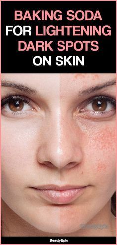 Lightening Dark Spots, Black Spots On Face, Spots On Skin, Brown Age Spots, Brown Spots On Skin, Spots On Legs, Dark Spots On Face, Brown Spots Removal, Brown Spots On Face