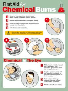 First Aid For Chemical Burns (2) | Safety Poster Shop First Aid Poster, First Aid Kit Checklist, Chemical Burn, First Aid Cpr, First Aid Tips, Safety Poster, Basic First Aid, Chemical Safety, Emergency First Aid