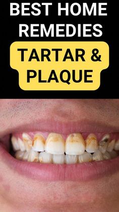 Plaque Removal At Home, Tartar Removal, Tooth Decay Remedies, Tooth Sensitivity, Receding Gums, Gum Care, Natural Teeth