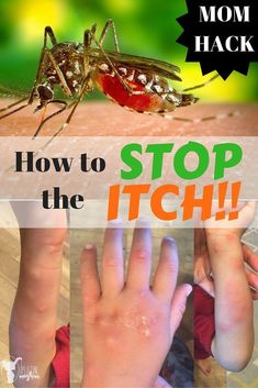 How To Stop Itching From Mosquitos, How To Make Mosquito Bites Stop Itching, How To Stop Mosquito Bites From Itching, Itchy Mosquito Bite Remedy, Mosquito Itch Relief, Mosquito Bites Stop Itching, Mosquito Bite Remedy, Mosquito Bite Relief