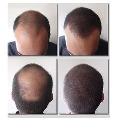 Hair Growth For Men, Good Morning Coffee Images, Coffee Images, Skincare Review, Healthy Scalp, Hair Images