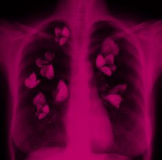 an x - ray image of the chest with butterflies on it's chest area