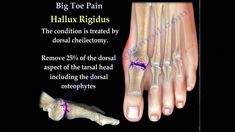 Dr. Ebraheim’s educational animated video describes painful conditions of the big toe. Big toe pain is fairly common, since the feet are constantly exposed t... Big Toe Pain, Diy Medicine, Diy Beauty Hacks, Medical Problems, Health Check