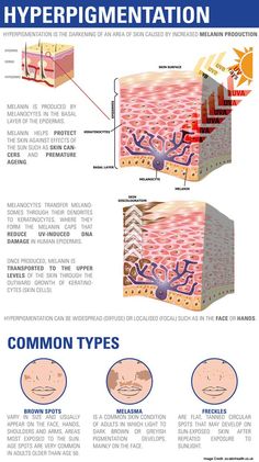 Types of Hyperpigmentation Natural Aging Skin Care, Beauty Hacks That Actually Work, Skin Care Specialist, Layers Of The Epidermis, Acne Vulgaris, Chemical Peels, Baking Soda Shampoo, Lighten Dark Spots, Peeling Skin