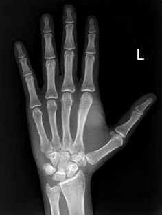 an x - ray image of a hand with the bones labeled l and f on it