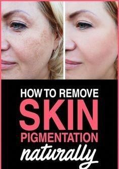 How To Remove Pigmentation Permanently At Home In Just 7 Days || Pigmentation Treatment || S.C Skin