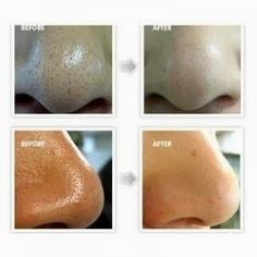 How to Make a Face Mask to Remove Blackheads: 2 egg whites whisked plus 1tsp lemon juice. Let harden 15-20 mins. Peel off. Mask To Remove Blackheads, Make A Face Mask, To Remove Blackheads, Blackheads On Nose, Remove Blackheads, Get Rid Of Blackheads, Mascara Facial, Egg White