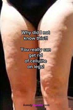 Wish i knew this before - simple natural remedies for legs with cellulite! How To Get Rid Of Leg Dimples, Tighten Thigh Skin, Natural Skin Firming Remedies, Cottage Cheese Legs How To Get Rid Of, Tighten Leg Skin, Saggy Legs Workout, How To Get Rid Of Cellulight, Fat Legs How To Get Rid Of, Exercise For Celulites