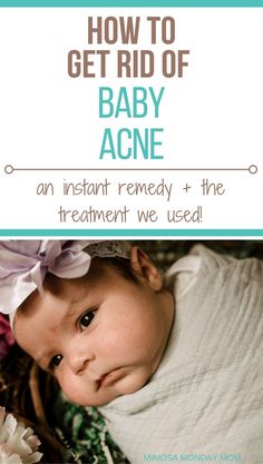 a baby laying on its back with the title how to get rid of baby acne