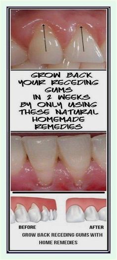 I can’t thank you enough. Exceptional information. Grow Back Receding Gums, Autogenic Training, Heal Cavities, Tooth Sensitivity, Homemade Remedies, Tooth Decay