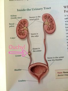 Raw Leafy Greens Friends or Foe? Kidney Stones and the Wisdom of Moderation | The Organic Kitchen Blog and Tutorials Kidney Stone Pain Relief, Kidney Pain, Urinary System