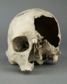 a human skull is shown on a gray background with the lower part missing from it