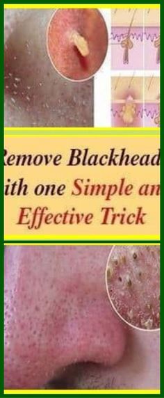 Natural Remedies For Cold, Removing Blackheads, Remedies For Cough, Blackheads Removal, Rid Of Blackheads, Remove Blackheads, Health Tips For Women, Natural Cold Remedies, Get Rid Of Blackheads