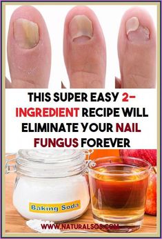 Get Rid Of Nail Fungus Forever 2 by michelle Taylor | This newsletter was created with Smore, an online tool for creating beautiful newsletters for educators, nonprofits, businesses and more 2 Ingredient Recipes, Fungal Nail, 2 Ingredient, Nail Fungus, Healthy Beauty, 2 Ingredients, Beauty Skincare, Health Remedies