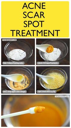 Face Mask Diy Skincare, Laser Acne Scar Removal, Baking Soda Face Mask, Acne Laser, Healthy Soda, Face Mask Diy, Baking Soda Face