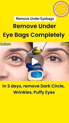 Home Remedies on Instagram: "NATURAL RECIPE TO REMOVE EYE BAGS UNDER remove  THE EYES AND DARK CIRCLES  Leve bags under the eyes  #darkcircles  #skin#naturalremedy circles  #womenshealth  #healthy#uganda#southafrica  #worldwide #naturalremedies  @slimsquadss" Eye Circle Remedies, Eye Health Remedies, Remove Eye Bags, Dark Eye Circles