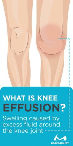 My Knee Hurts, Swollen Knee, Nerve Pain Relief, Knee Pain Relief