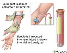 Prostate-specific antigen (PSA) is a glycoprotein in the cytoplasm of prostatic epithelial cells C Reactive Protein, Phlebotomy, Eyes Problems, Blood Test, Favorite Pins, Health Tips, Medicine, Medical, Health