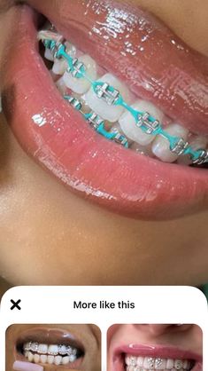 Braces Colors Ideas Cute Aesthetic, Cute Color For Braces, Braces For Brunettes, Teal Braces For Teeth, Braces Sky Blue, Braces Light Blue, Teal Braces Aesthetic, Bright Braces Colors, Blue Braces Aesthetic