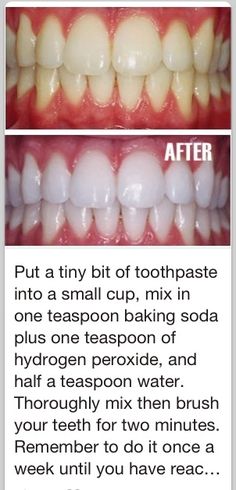 Dental Decay, Teeth Whitening Homemade, Teeth Whitening Remedies, Teeth Whitening Diy, Best Teeth Whitening, Oral Care Routine, Natural Teeth Whitening, Natural Teeth, Teeth Care