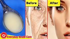 Apply This Mask In 5 Minutes - Remove Wrinkles And Dark Spots On The Fac... Face Wrinkles Remedies, Wrinkles Remedies Face, Home Remedies For Wrinkles, Mouth Wrinkles, Homemade Wrinkle Cream, Wrinkle Remedies, Skin Tightening Face, Lip Wrinkles, Skin Care Wrinkles