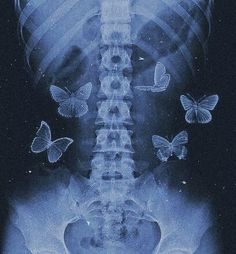 an x - ray image of a man's back with butterflies on it