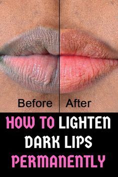 Lighten Dark Lips, Remedies For Glowing Skin, Home Remedies For Pimples, Dark Lip, Lip Scrub Homemade