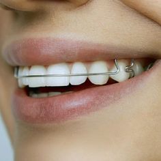 Braces For Teeth, Jewelry Teeth, Braces Colors Ideas, Teeth Gems, Braces Cost