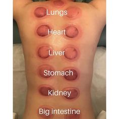 How does Cupping Therapy Help for Detoxification? - Balance Health Cupping Points, Wet Cupping, Punkty Spustowe, Massage Art, Benefits Of Cupping, Full Body Massage Techniques, Body Massage Techniques, Cupping Massage