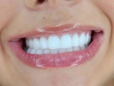 perfect white teeth strong teeth gape free teeth plaque free teeth healthy White teeth cavity free teeth permanent healthy White teeth Perfect White Teeth, Teeth Plaque, Botox Lips, Strong Teeth