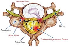 Causes Of Back Pain, Pinched Nerve, Neck Pain, Physical Therapy, Nerve, Black Belt