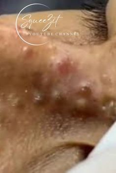 Watch how a professional removes blackheads from a man's nose. Satisfying pimple popping at it's best. Deep Pimple, Nose Pimples, Blackheads On Face, Remove Blackheads From Nose, Regular Skin Care Routine, Blackhead Remedies