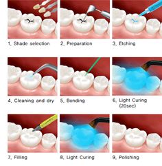 tooth-sealant-process-puyallup-cosmetic-dentistry Dental Assistant Study Guide, Dental Assistant School, Dental Hygienist School, Cosmetic Dentistry Veneers, Dental Assistant Study, Dentist Assistant, Dental Hygiene Student