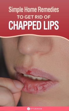 Chapped Lips Remedy, Drink Enough Water, Baby Lips, Cracked Lips, Drink Plenty Of Water, Health Vitamins, Natural Cough Remedies, Braut Make-up