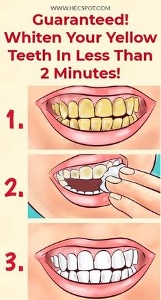 Teeth Whitening Diy, Whiten Your Teeth, Yellow Teeth, Teeth Health, Receding Gums, Natural Teeth Whitening, Natural Teeth, Oral Health Care, White Teeth