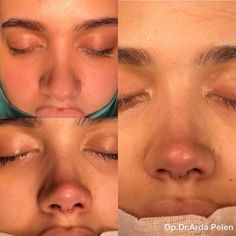 Eyebrow Growth Oil, Nose Plastic Surgery, Nose Surgery Rhinoplasty, Ethnic Rhinoplasty, Natural Eyebrows Growth, Nose Fillers, Rhinoplasty Nose Jobs, Rhinoplasty Before And After, قلادات متدلية