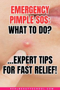 woman with a big pimple How To Deal With Pimples, What To Put On Pimples Overnight, How To Bring A Pimple To A Head Fast, Deep Pimple Remedies Overnight, Pimple Redness Reducer, How To Remove A Pimple Instantly, Getting Rid Of Pimples Fast, Quickest Way To Get Rid Of Pimples, How To Heal Popped Pimples Fast