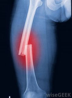 an x - ray view of the knee showing pain in the lower leg and upper thigh