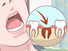 When a tooth is extracted, a wound is created within the gums and alveolar bone. Improper care can lead to serious and painful complications. Knowing how to take the necessary precautions before and after the extraction procedure will... Eating After Tooth Extraction, Wisdom Teeth Swelling, Wisdom Teeth Recovery, Tooth Pain Remedies, Wisdom Teeth Pain, Tooth Extraction Aftercare, Tooth Extraction Healing, Teeth Surgery, Dental Extraction