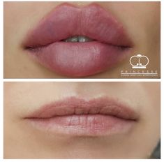 Round Lip Filler Shape, Round Lip Filler, 90s Latina Makeup, Round Lips, Lip Fillers Juvederm, Big Lips Natural, Facial Fillers