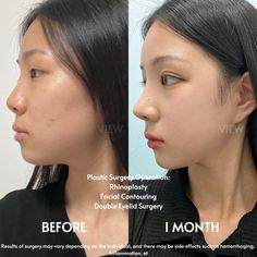 For more information: ❤️Whatsapp: +82-10-2103-7174 💛Kakao: viewinquiry 💚LINE: viewinquiry ✉️E-mail: eng_viewps@viewclinic.com 💎Website: www.viewplasticsurgery.com Facial Bones, Korean Language, Kourtney Kardashian, Aesthetic Makeup