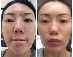 Perioral Dermatitis Natural Cure - I saw results in two weeks! Contact Dermitis Face, Perioral Dermitis Skincare, Perioral Dermitis Causes, Perioral Dermitis Remedies, Sun Damage, Hot Yoga, Natural Remedies, I Saw, Facial