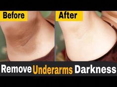 Lighten Dark Underarms at Home | Get Rid Of Dark armpit NaturallyUnderarms Whitening At Home | Get Rid Of Dark Underarms Naturally#armpit #underarms #darkund... Get Rid Of Dark Armpits, Rid Of Dark Underarms, Dark Armpits, Arm Pits, Cold Sore, Unwanted Hair