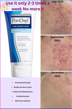 As I am acne free now I want to share with you the best and affordable products I used. #acnetreatment #acne #acnefighter #acnetips #panoxyl Good Acne Products, Panoxyl Cleanser, Panoxyl Face Wash Before And After, Back Acne Products, Body Acne Products, Skincare Board, Forehead Acne, Acne Products, Best Acne Products