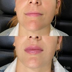 Lip Filler Technique, Mini Face Lift, Botox And Filler, Lip Lift, Danielle Smith, Champagne Problems, Lip Augmentation