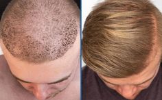 Read Or Download Men's Hair Replacement Cost at Men Hair Cut Androgenic Alopecia, Hair Implants, Hair Transplant Cost, Hair Transplant Results, Hair Transplant Procedure, Fue Hair Transplant, Hair Transplant Surgery, Best Hair Transplant, Herbal Hair