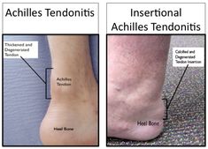 Sore Achilles Tendon, Insertional Achilles Tendinopathy, Achilles Tendon Pain Relief, Calcaneal Spur, Haglunds Deformity, Achilles Tendon Ruptures, Achilles Tendinopathy, Elbow Exercises, Achilles Pain