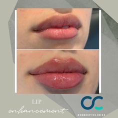 Women With Lip Fillers, Full Lips Fillers, Getting Lips Done, Lip Augmentation Shapes, Lip Fillers Cupids Bow, Pillow Lip Filler, Bow Shaped Lips Filler, Bottom Heavy Lip Filler, Lips Filer Shape