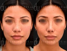 Korean Nose Job, Nostril Reduction, Nose Fillers